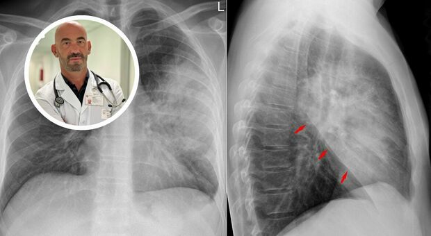 Polmonite, boom di casi. Bassetti: «Ospedali già pieni». Sintomi, cause, cure e cosa non fare