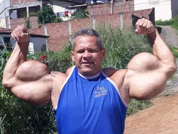 Il bodybuilder Anomalia, con bicipiti da 73 cm potenziati dal Synthol, è scomparso a 55 anni