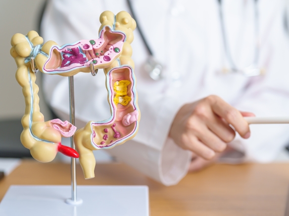 Aumento dei decessi per tumore del colon-retto negli under 50 negli Stati Uniti e la situazione in Italia