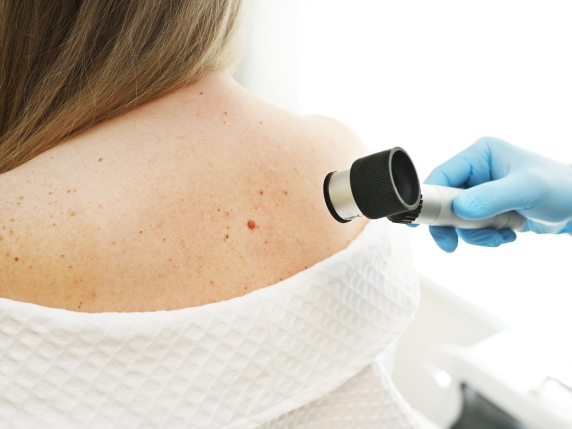 Melanoma in fase iniziale: quasi tutti i pazienti guariscono dopo il trattamento