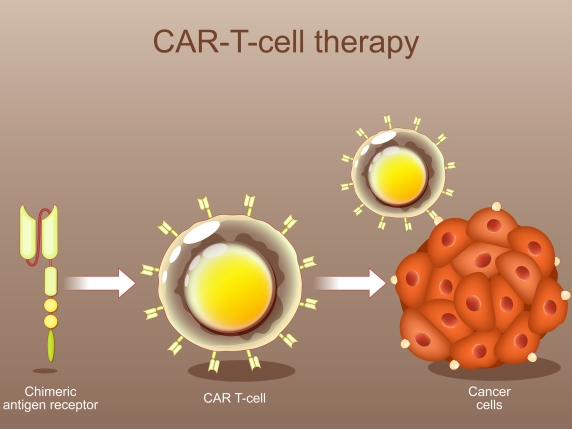 Nuova terapia CAR-T per pazienti con linfomi che non rispondono ai trattamenti standard
